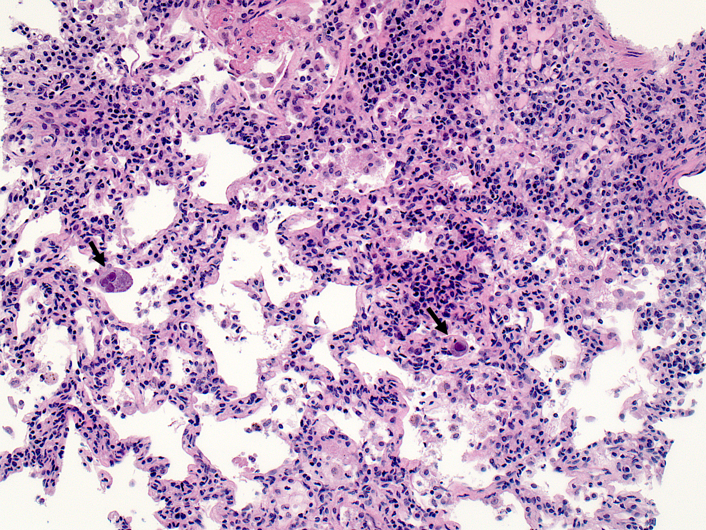 CMV infected cells (arrows) in the lung with intranuclear eosinophilic viral inclusions