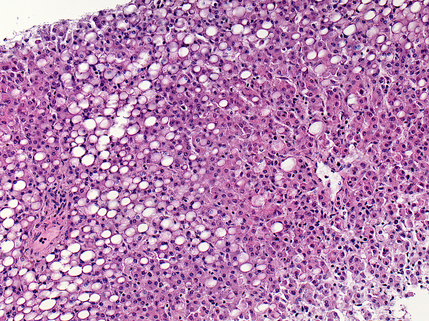 Fat droplets (clear spaces) within hepatocytes due to steatosis from malnutrition