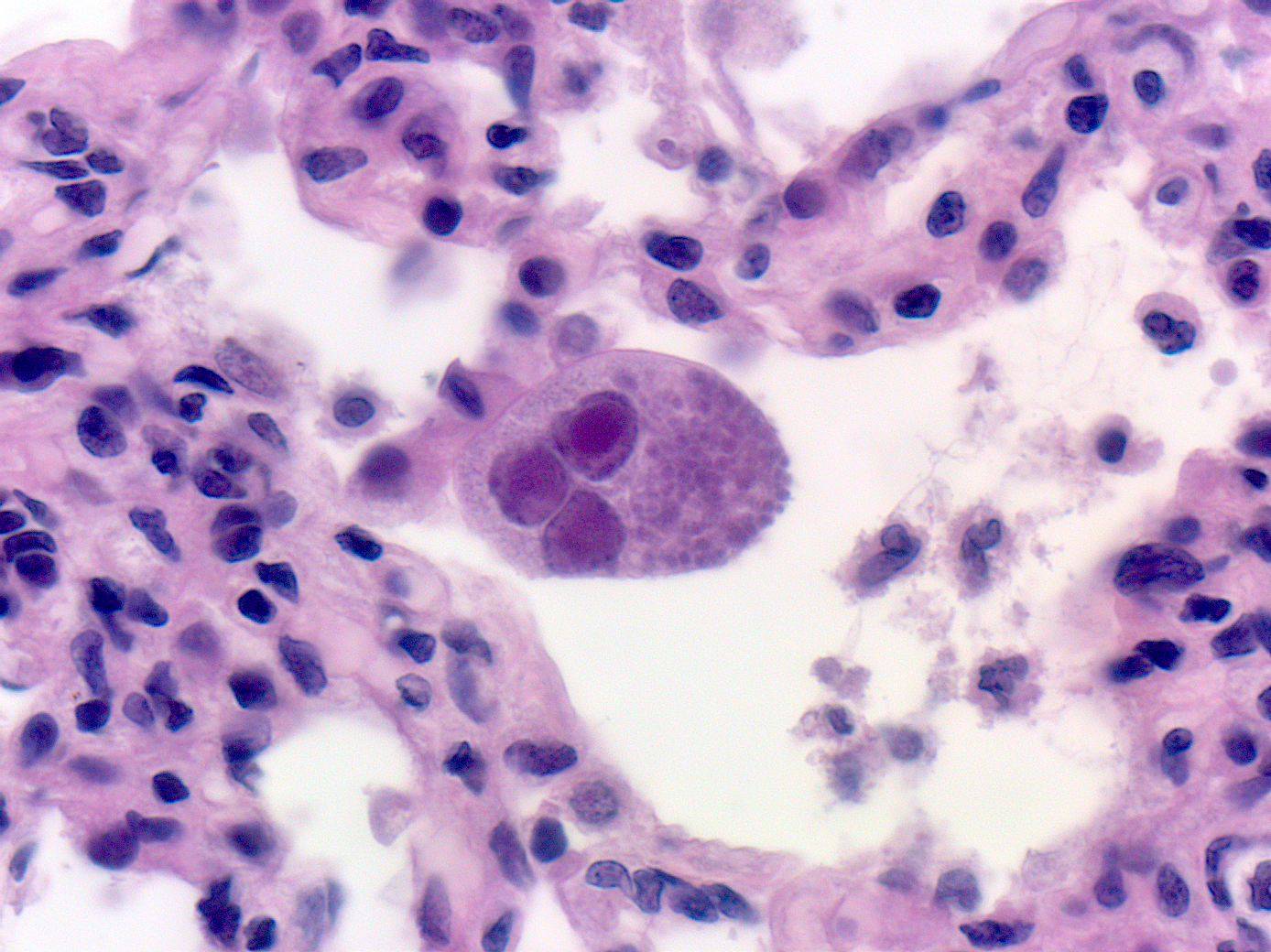 CMV infected cell in the lung with intranuclear eosinophilic viral inclusions