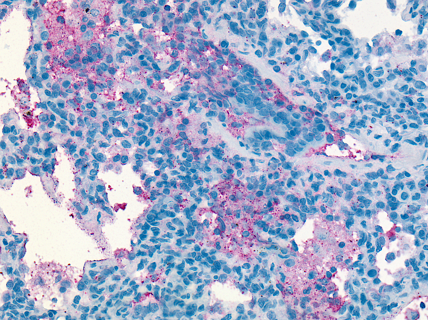 Abundant Streptococcus spp. bacteria seen by immunohistochemistry in the lung